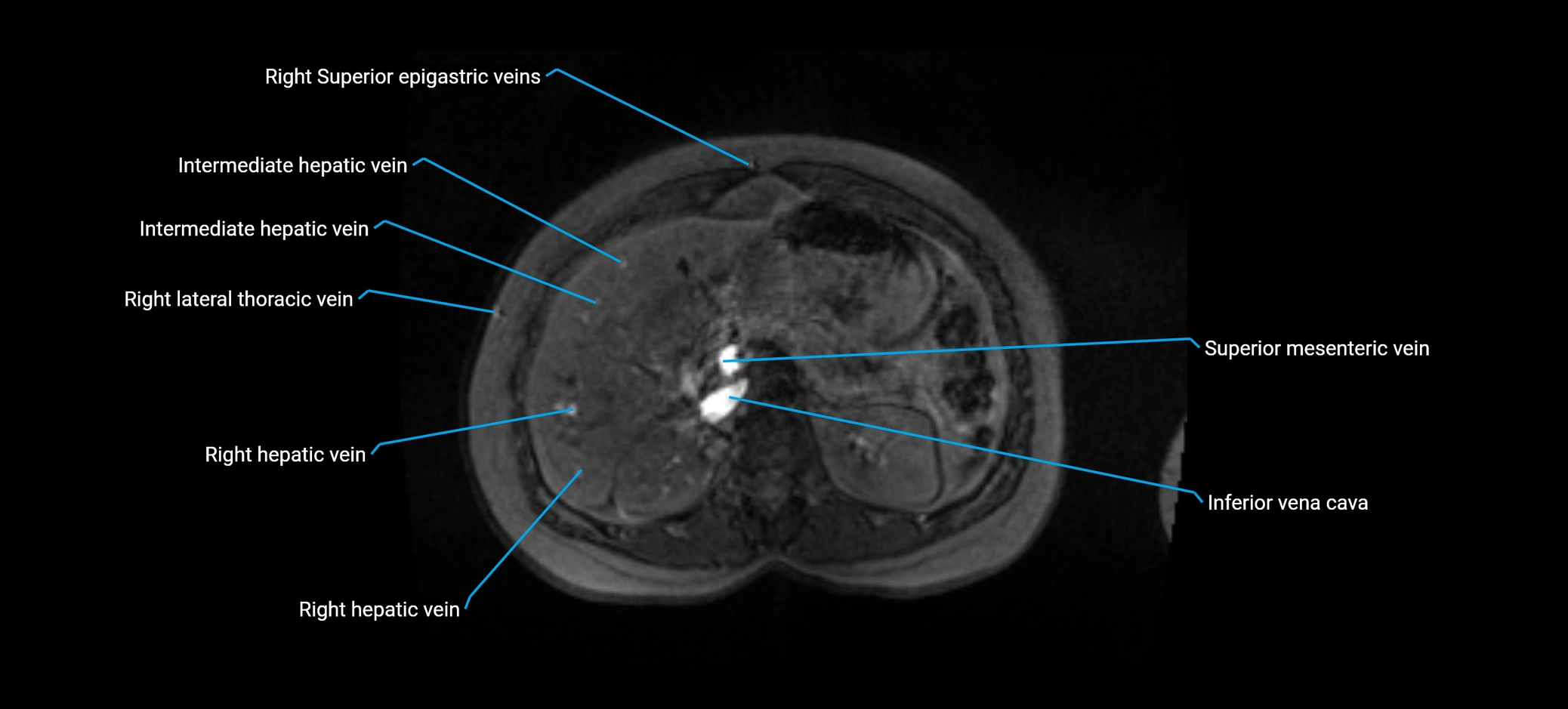 MRV abdomen pelvis & lower limb axial cross sectional anatomy labelled MRI image 54 (1).webp